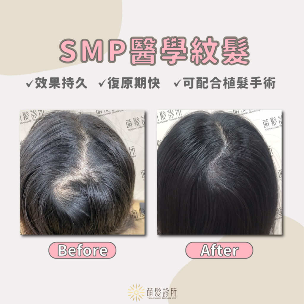 SMP醫學紋髮給稀疏頭頂打造濃密效果