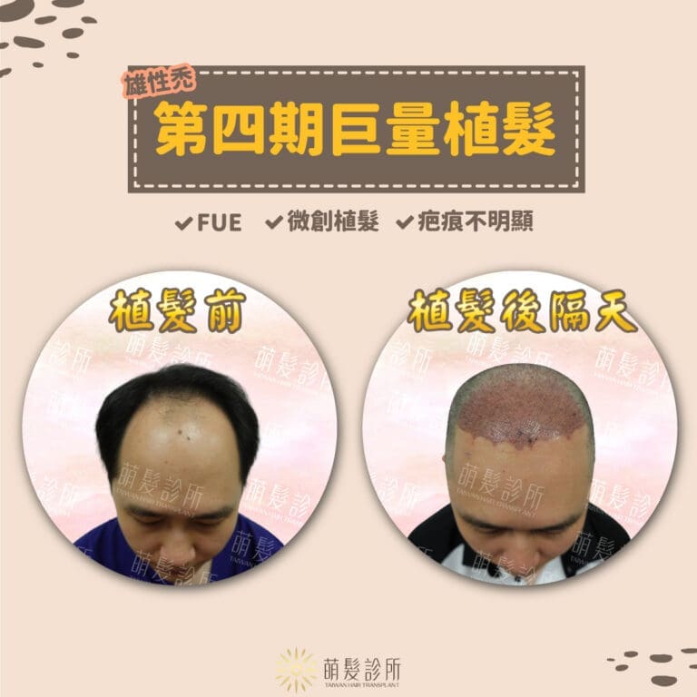 FUE微創植髮手術搶救雄性禿第四期