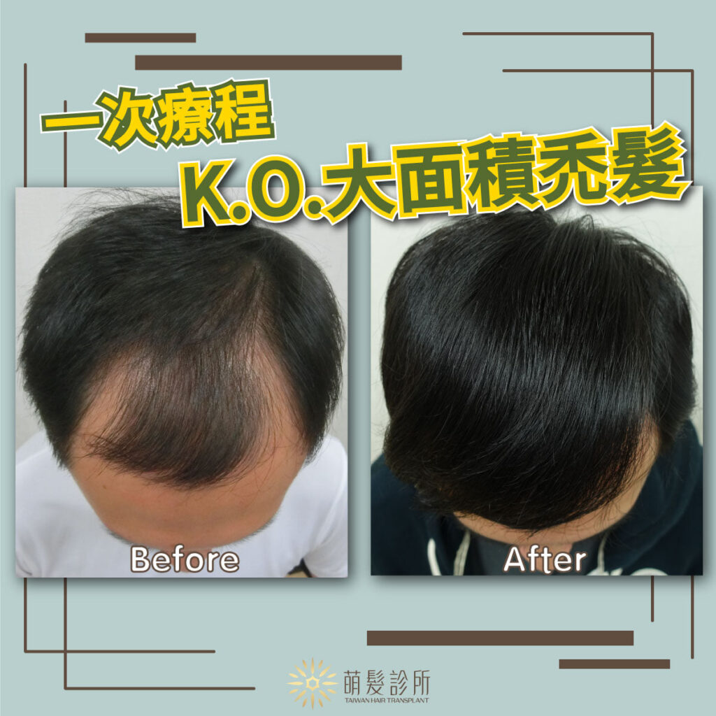 大面積植髮/巨量植髮，一次療程逆轉雄性禿