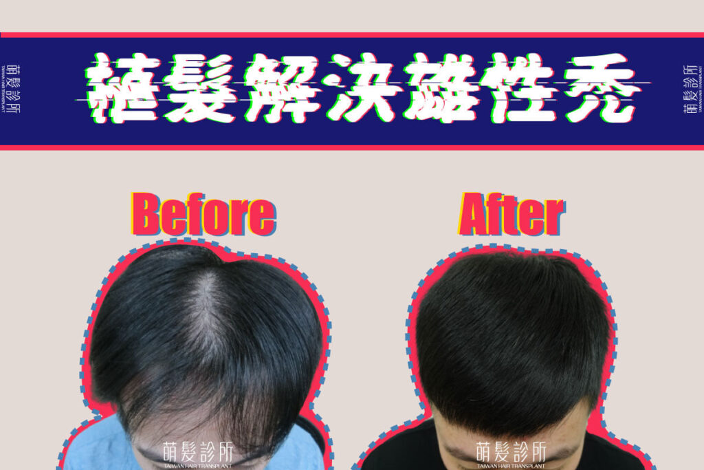 雄性禿導致頭髮稀疏、髮際線後退植髮可以幫你改善