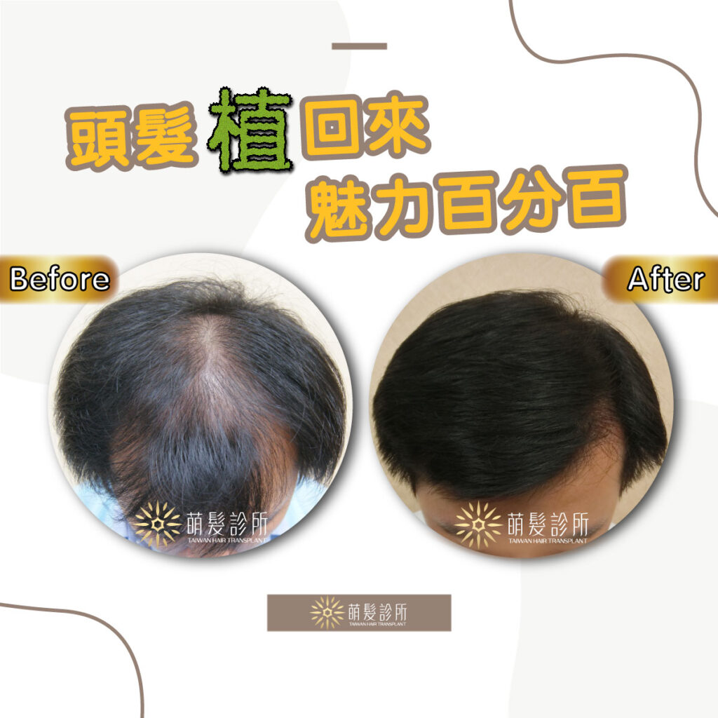 植髮可以解決遺傳雄性禿的困擾