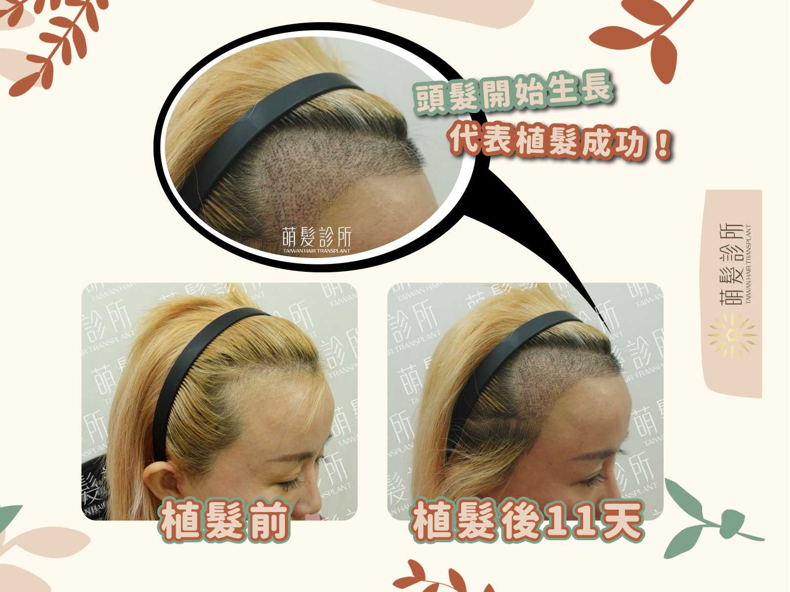 女性高髮際線植髮術前與術後十一天紀錄