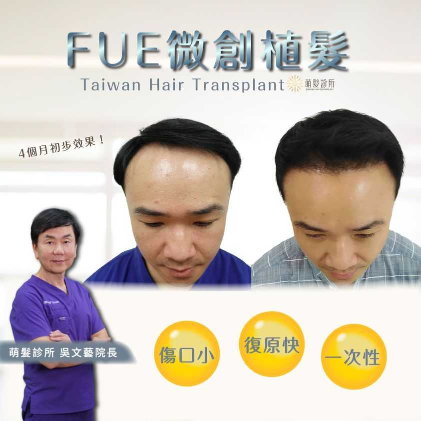 陳先生植髮第四個月頭髮剪短或做造型都不是問題