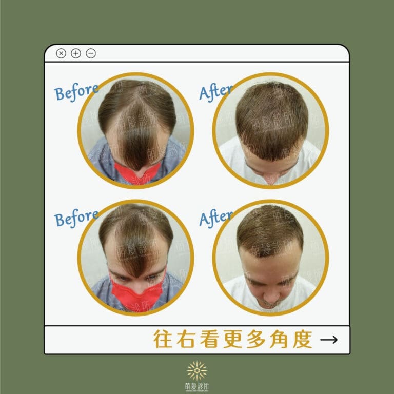 M型禿植髮八個月擺脫兩角空洞