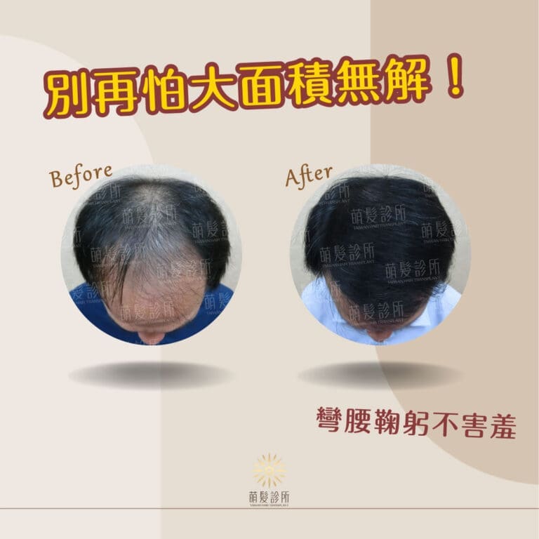 有大面積掉髮的困擾？別再說自己頭髮沒救了