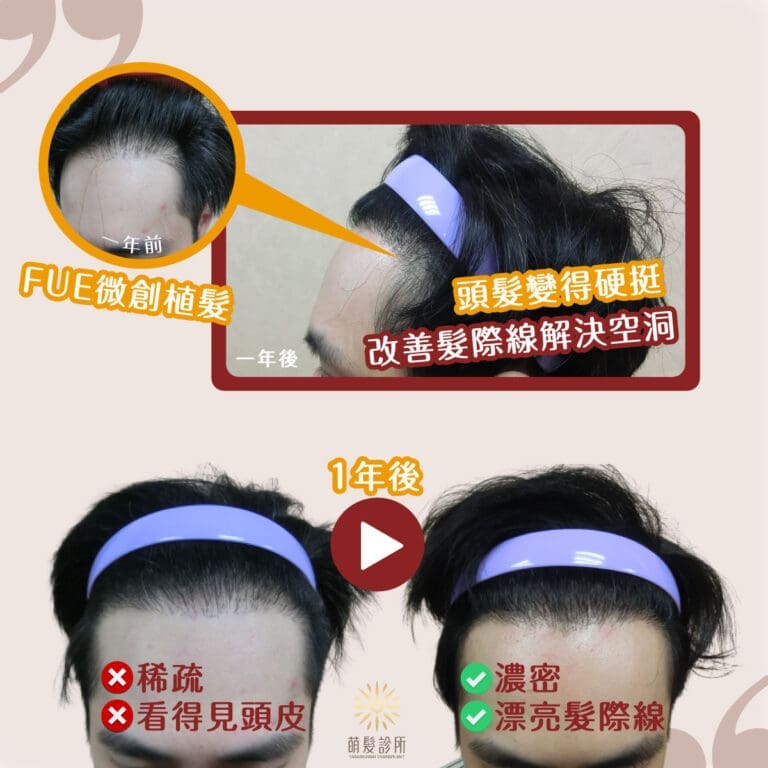 FUE微創植髮案例:讓張先生髮際線更濃密