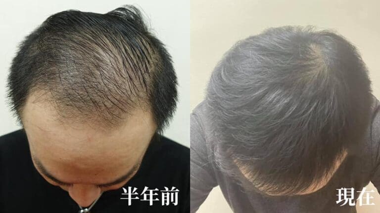 南部的Y先生植髮6個月改善大面積禿髮