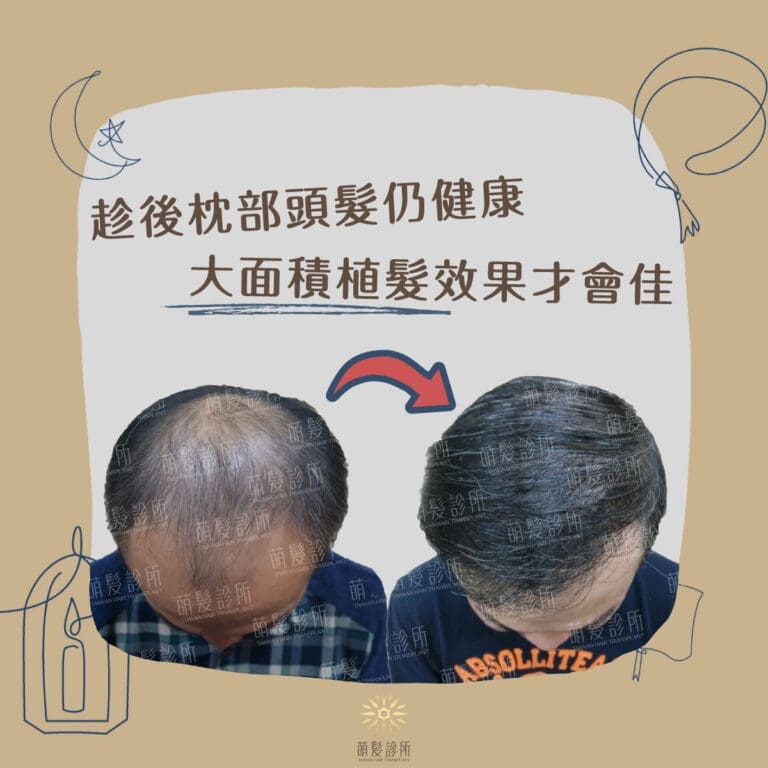 如何讓大面積植髮的效果最佳?