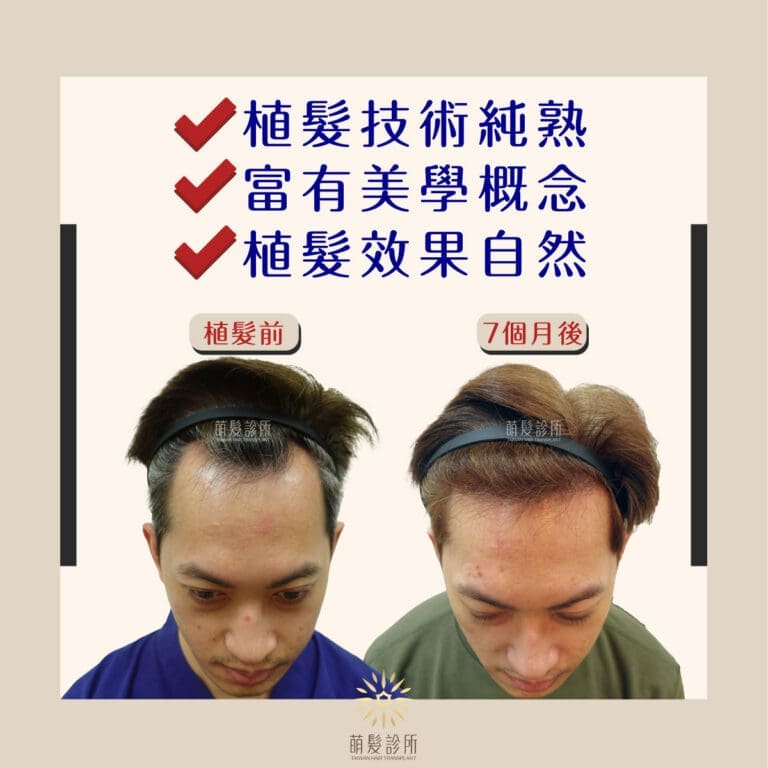醫師和團隊的美學與經驗會影響植髮效果嗎?