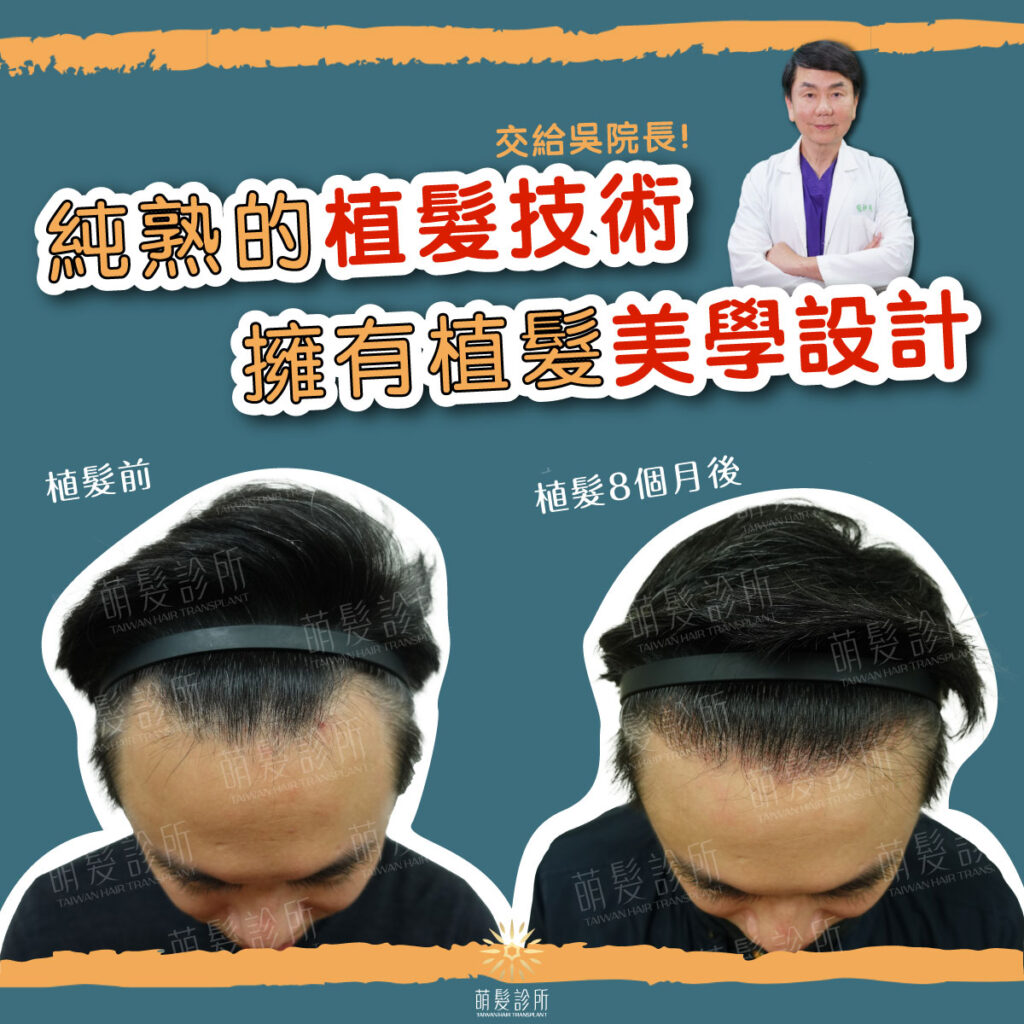 植髮改善M型空洞，8個月恢復漂亮髮際線