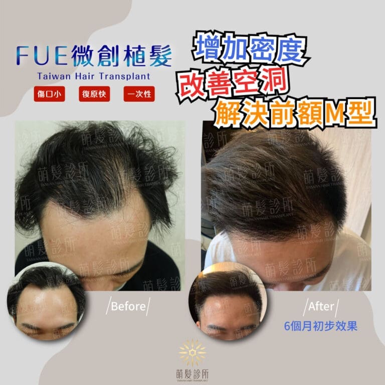 FUE微創植髮6個月後效果驚人！半年前後差異超大！