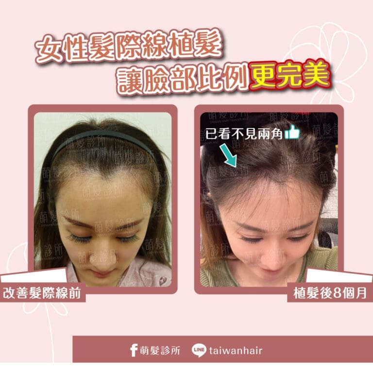 女性美人尖與兩側額角植髮案例｜術後 8 個月正面影像紀錄