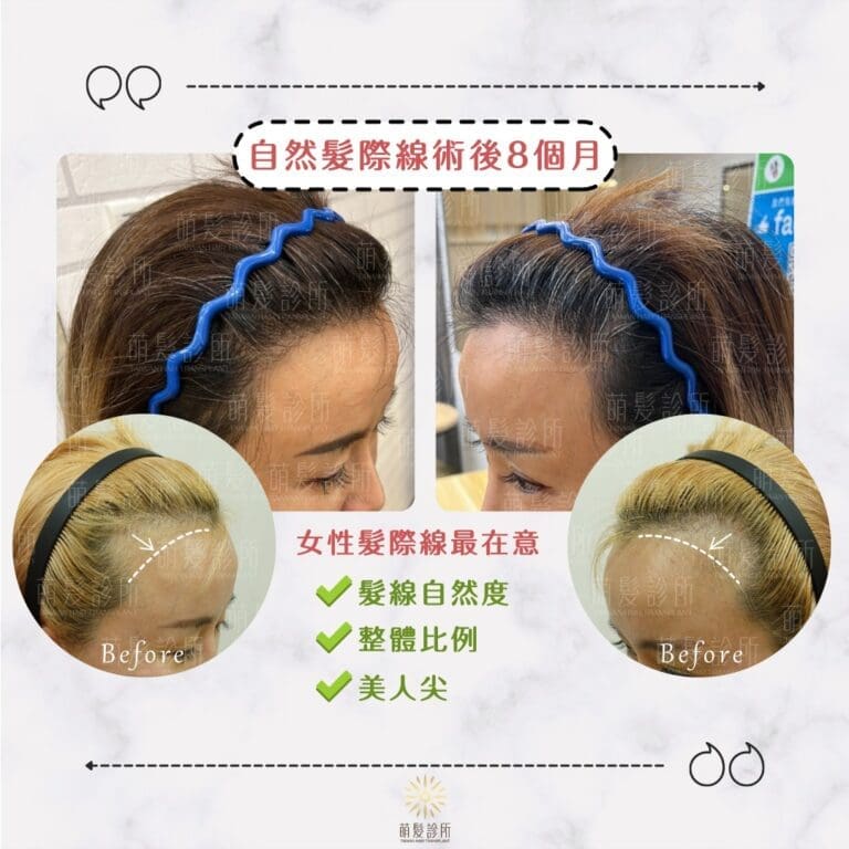 女性植髮後 8 個月生長追蹤案例｜兩側額角影像紀錄