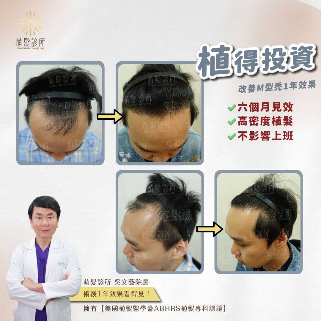 M 型禿植髮一年後髮際線案例紀錄