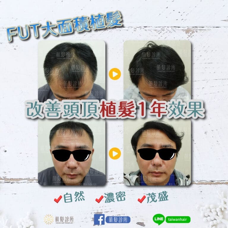 FUT植髮3000株沒問題,大面積禿髮困擾看這篇！