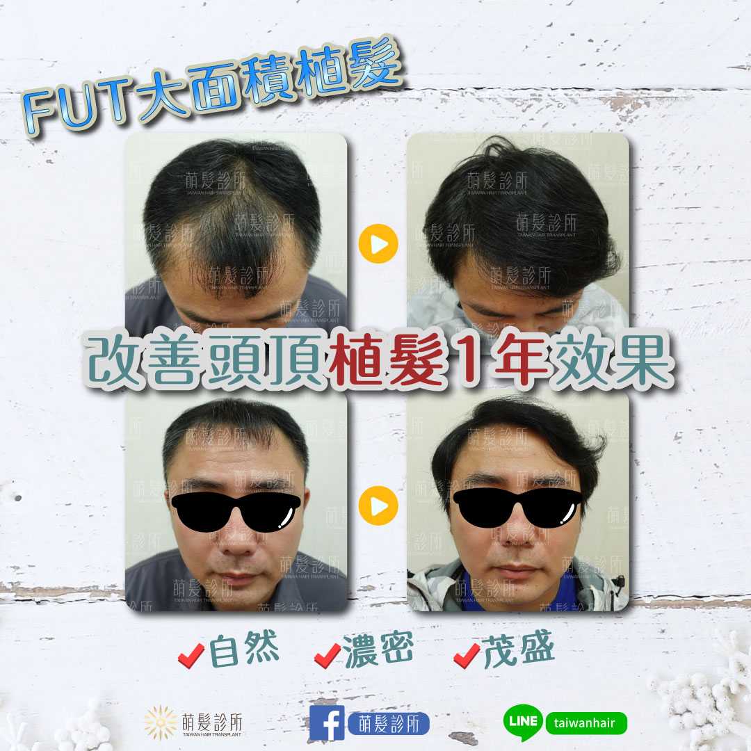 FUT 巨量植髮 3000 株案例紀錄
