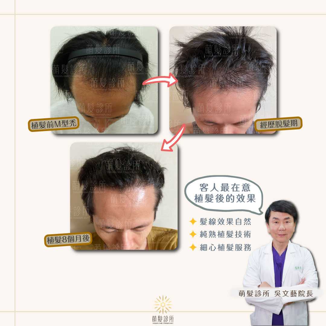 M 型禿前額髮際線植髮案例紀錄
