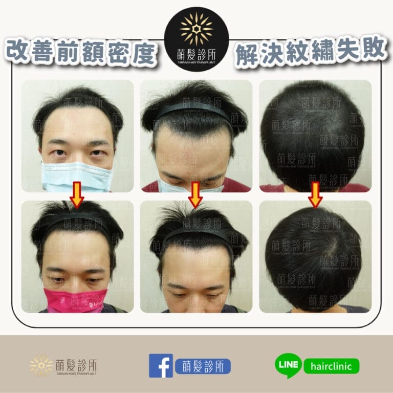 紋髮/植髮失敗交給吳文藝院長來幫您搶救