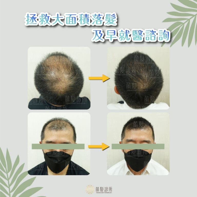 大面積落髮植髮建議及早就醫諮詢！