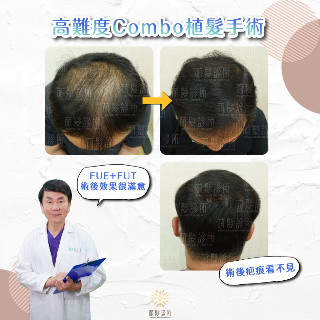 我可以做Combo(FUE+FUT)植髮手術嗎?