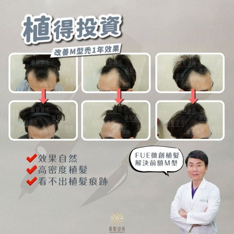 植髮手術不可怕，怕的是越來越後退的M型禿