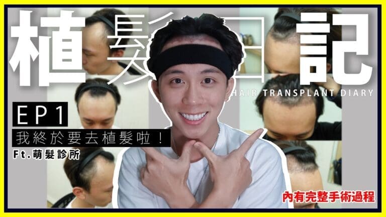 M型禿Youtuber WUNTAI 植髮真實記錄-植髮日記EP1