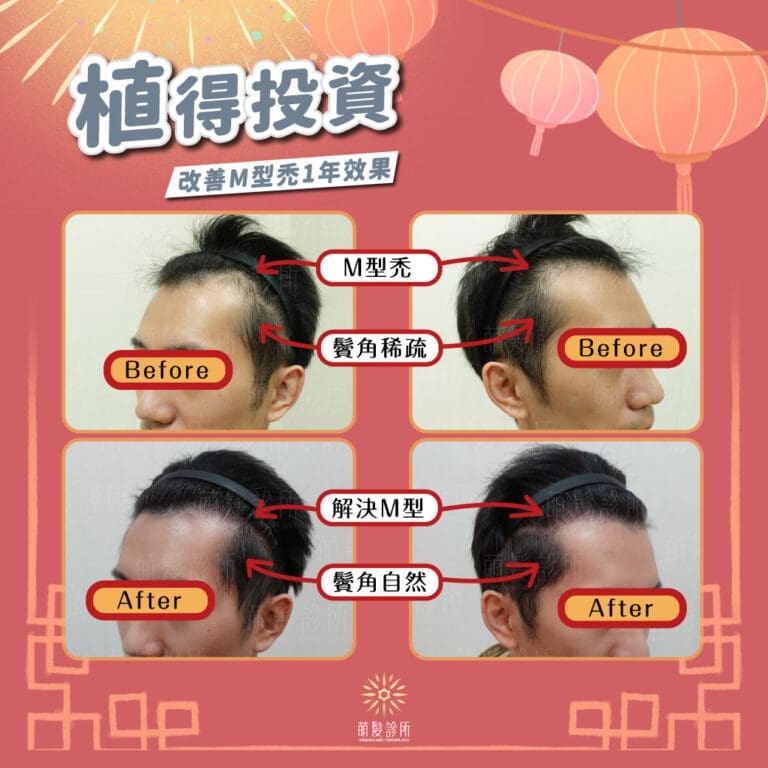 植髮解決M型禿增加鬢角密度