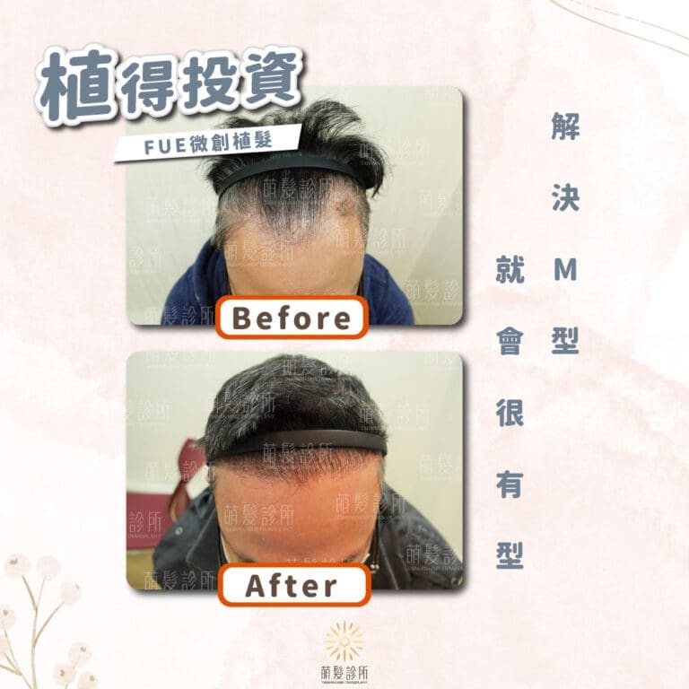 想植髮就該選擇自然的微創植髮手術