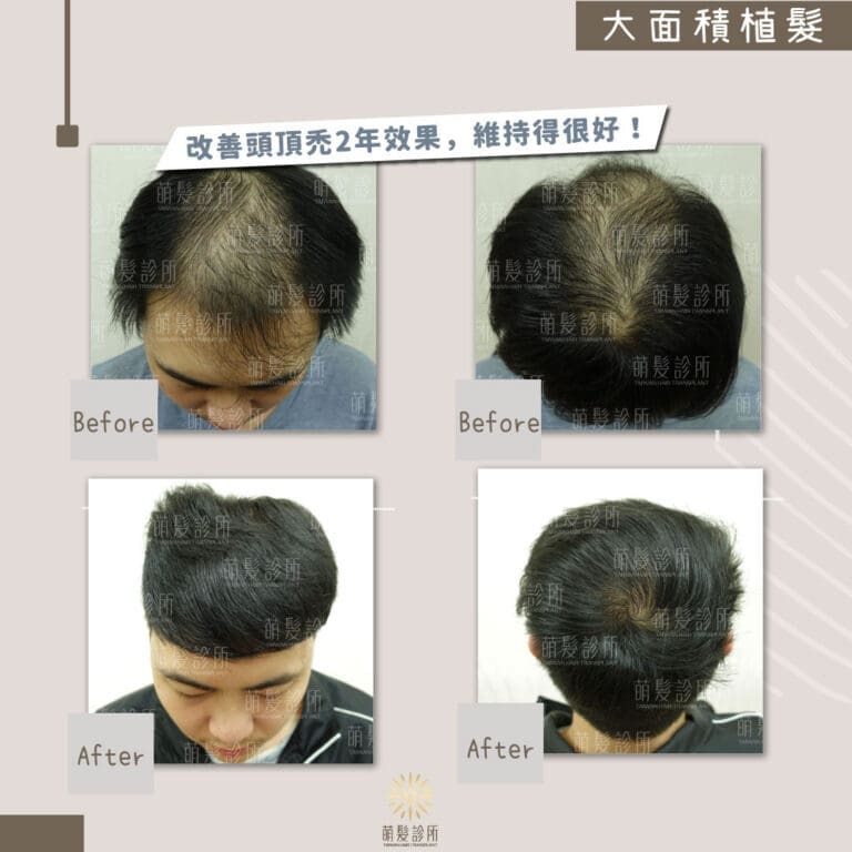 大面積植髮效果如何?植髮是永久的趁年輕時及早諮詢