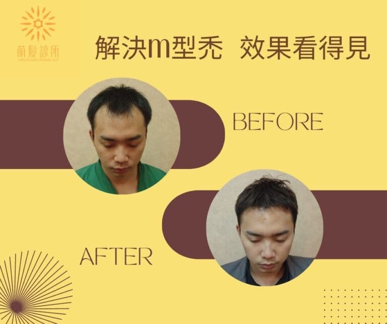 M型禿頂讓你的自信心越來越低嗎？