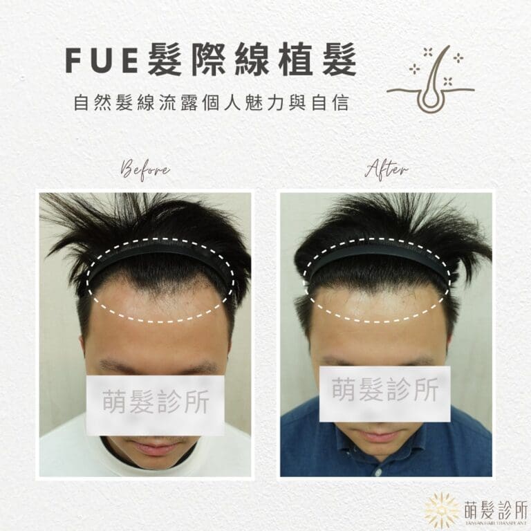 超越期待！髮際線植髮令人驚豔的改變