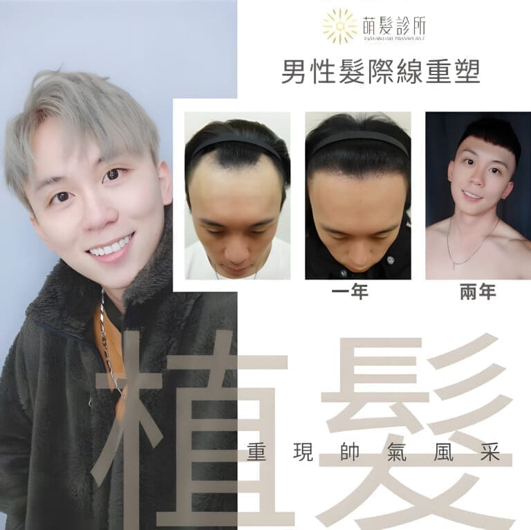 YouTuber WT 已植髮滿2年了！