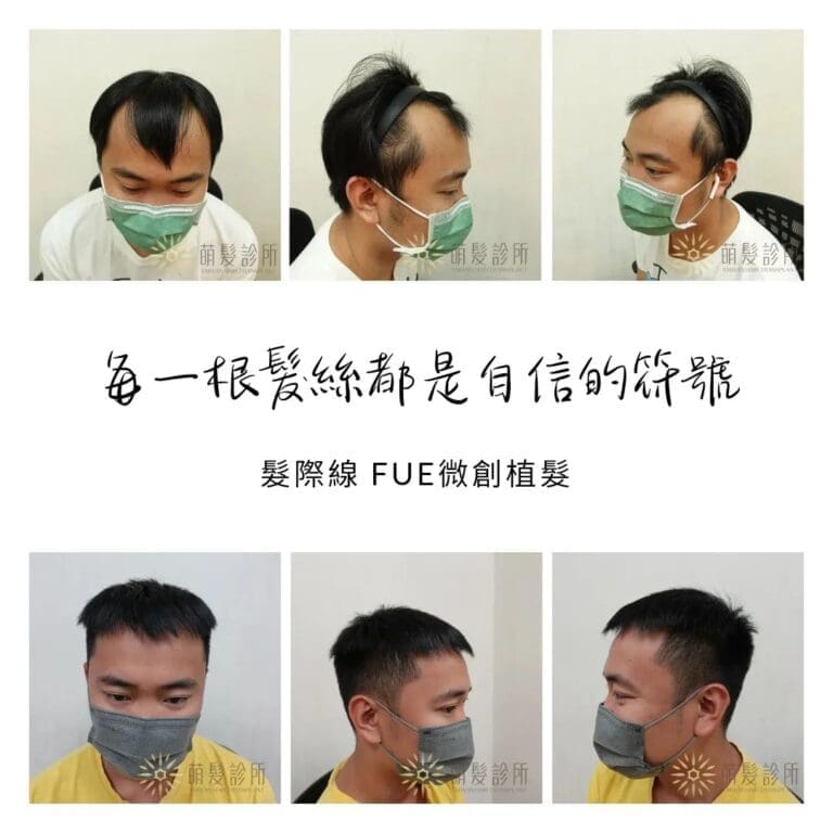前額兩角植髮的成功案例