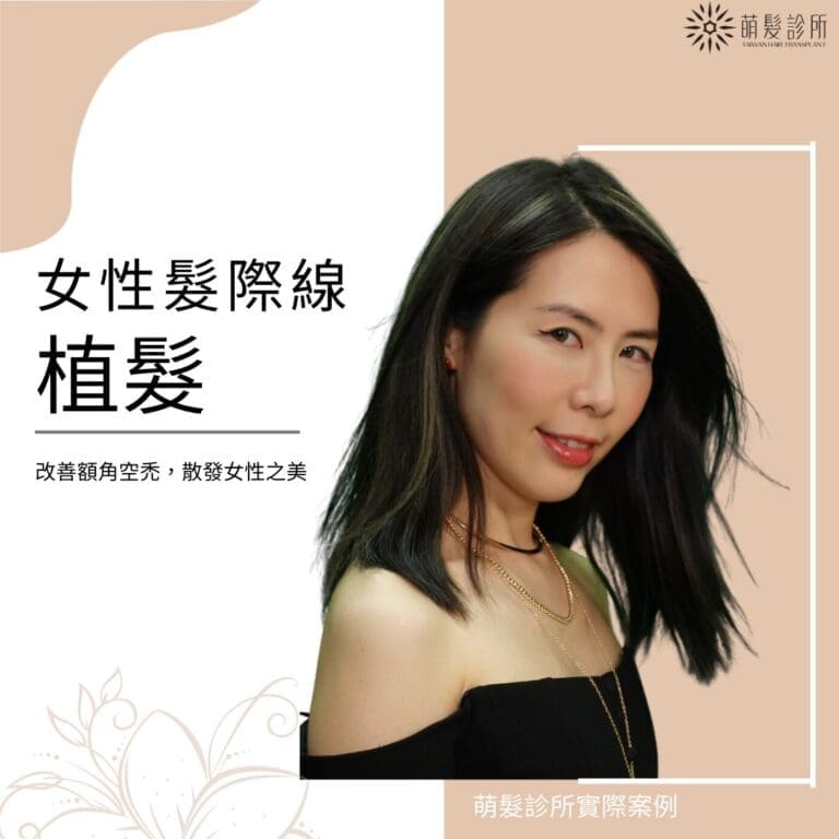 女性髮際線過高怎麼辦?
