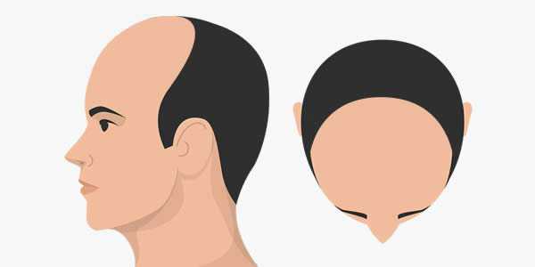 FUE植髮手術是什麼，適合短髮,植鬍鬚,植眉與局部掉髮嗎 ?