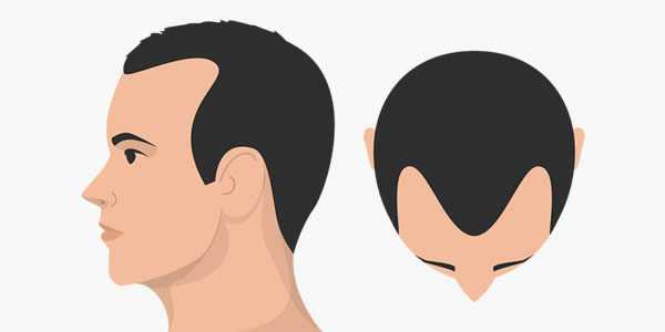 FUE植髮手術是什麼，適合短髮,植鬍鬚,植眉與局部掉髮嗎 ?