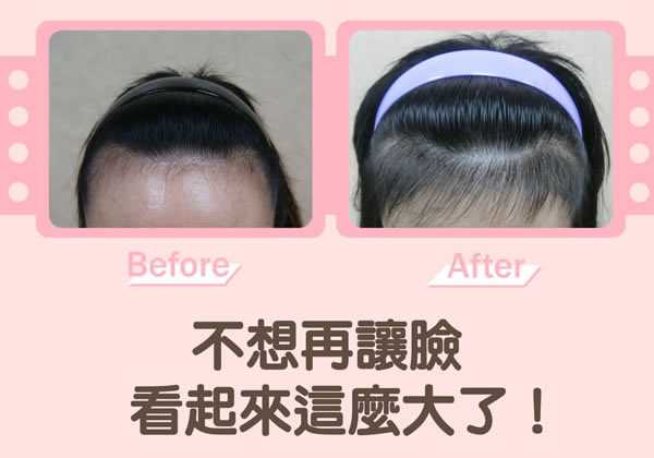 髮際線修復手術 針對M型禿或高額頭的女性設計