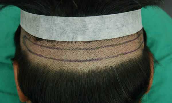 FUT 巨量植髮手術適合大量掉髮的大面積植髮手術