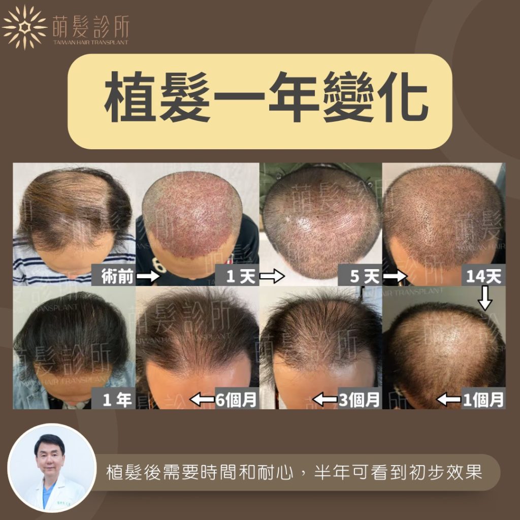 FUE 植髮多久可看到明顯的植髮效果?