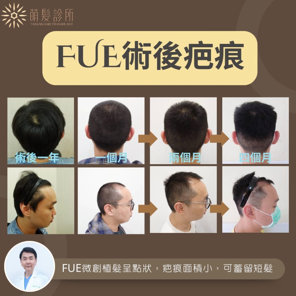 FUE 取髮部位還會再長出新髮嗎?