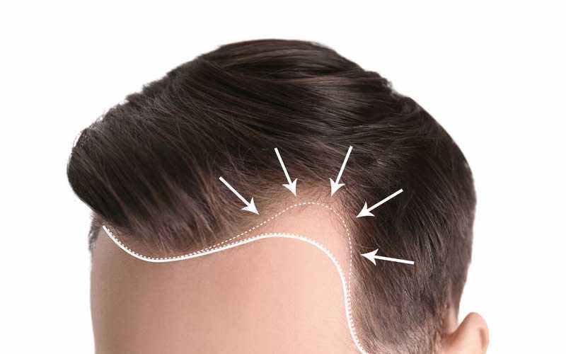 M型禿植髮-前額及頭頂髮際線調整