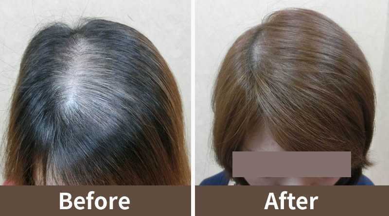 女性植髮適合掉髮&女性雄性禿 頭髮稀疏 高髮際線後退嗎?