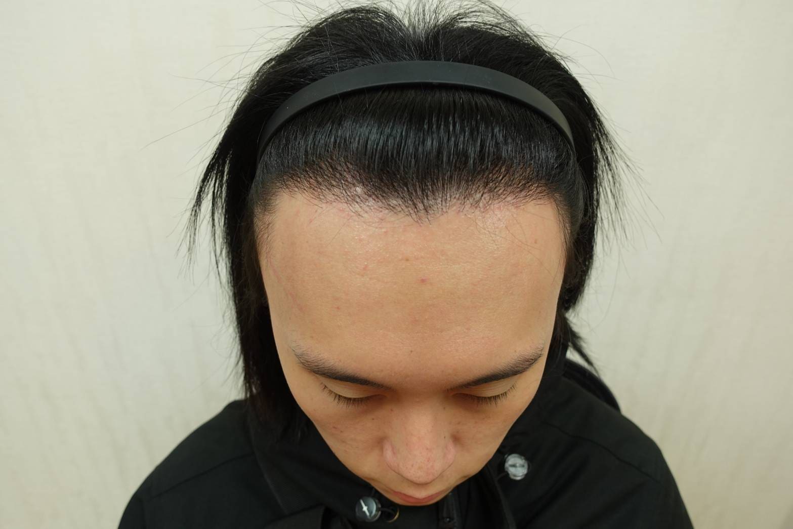 術後回診追蹤頭髮生長狀況