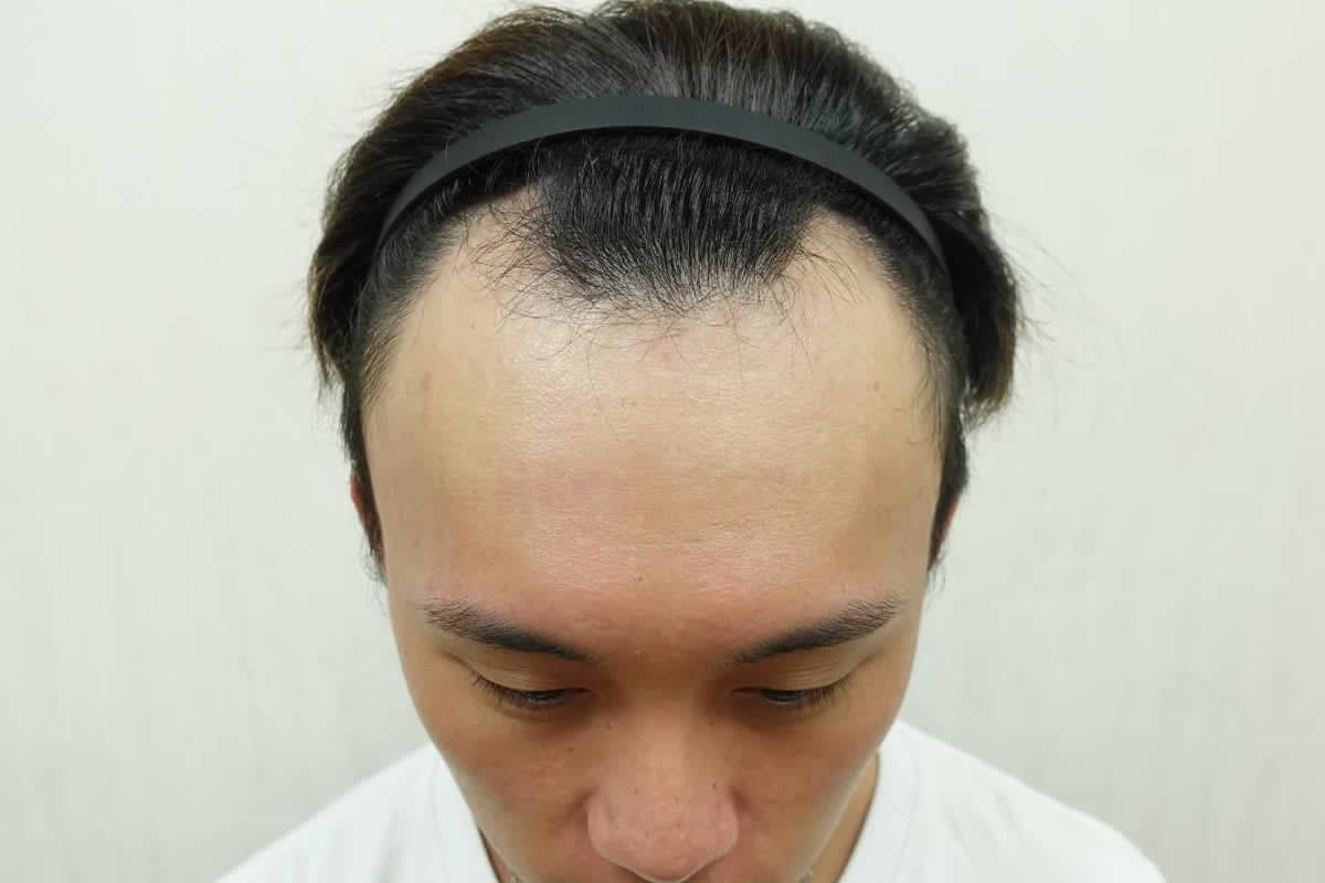 FUE 植髮案例:植髮前