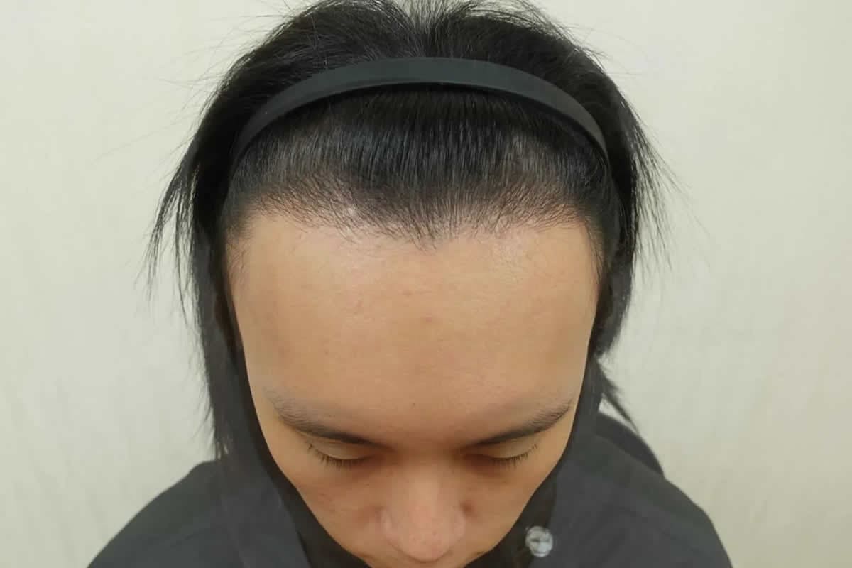 FUE 植髮案例:植髮後