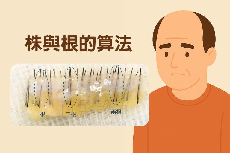 植髮為什麼以株計算？