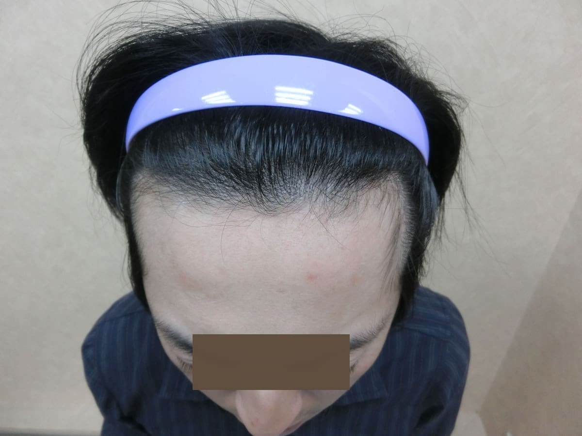 FUE 1121 株額前髮際線俯視案例:植髮後