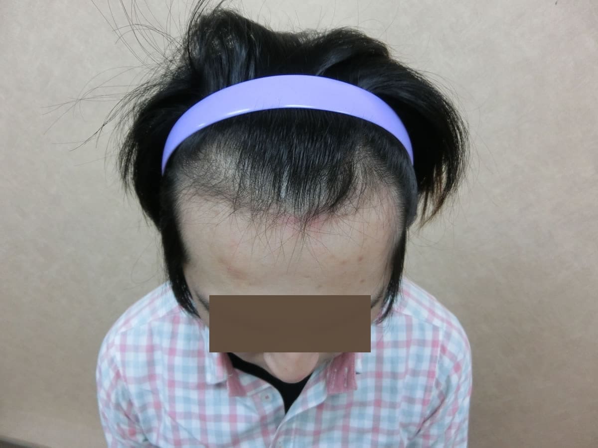 FUE 1121 株額前髮際線俯視案例:植髮前