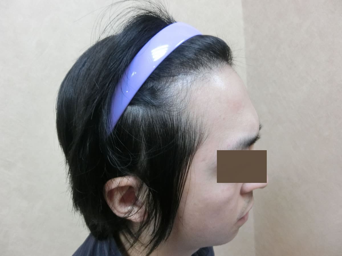 FUE 1121 株額前髮際線前上方案例:植髮後