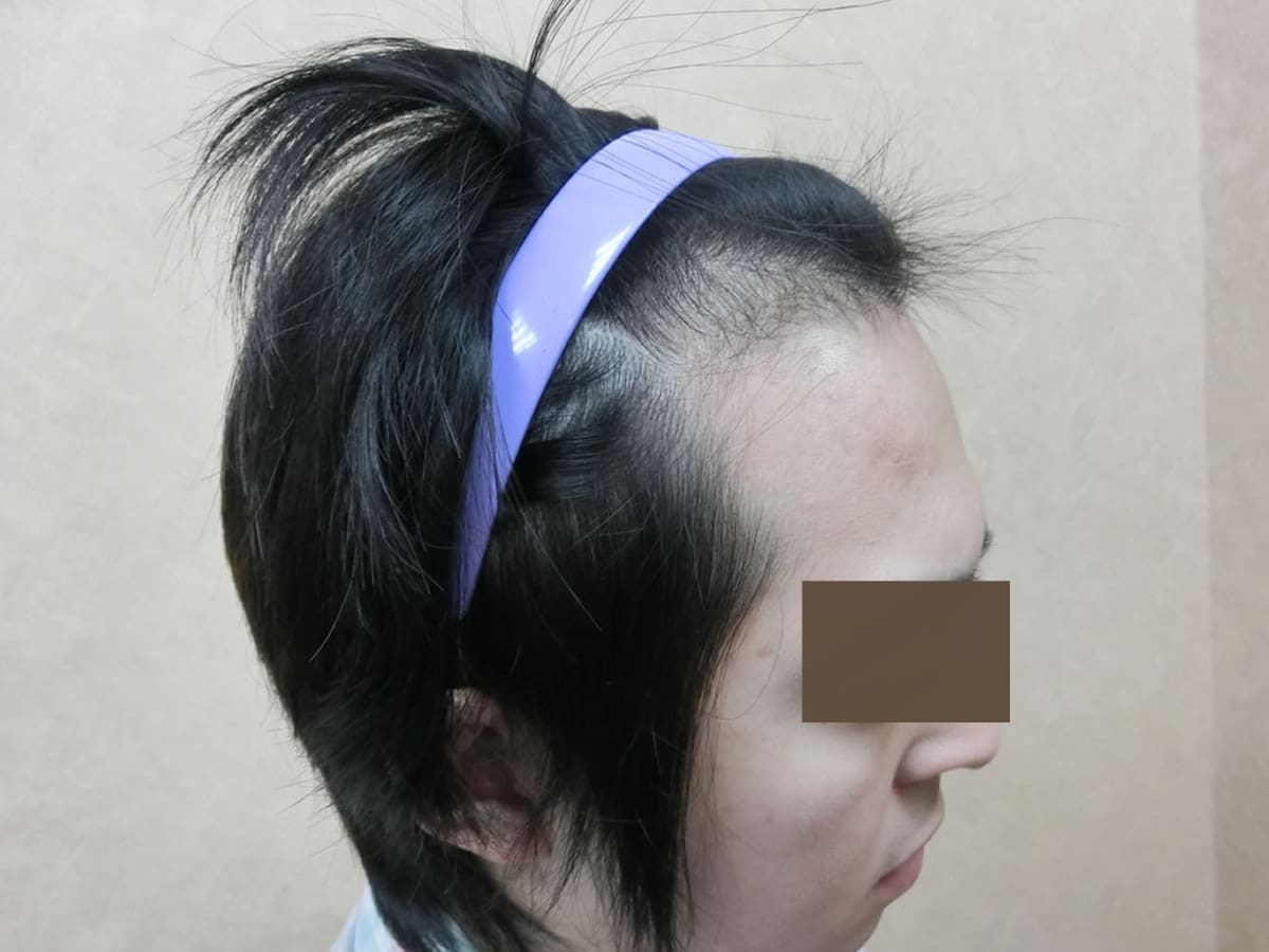 FUE 1121 株額前髮際線前上方案例:植髮前